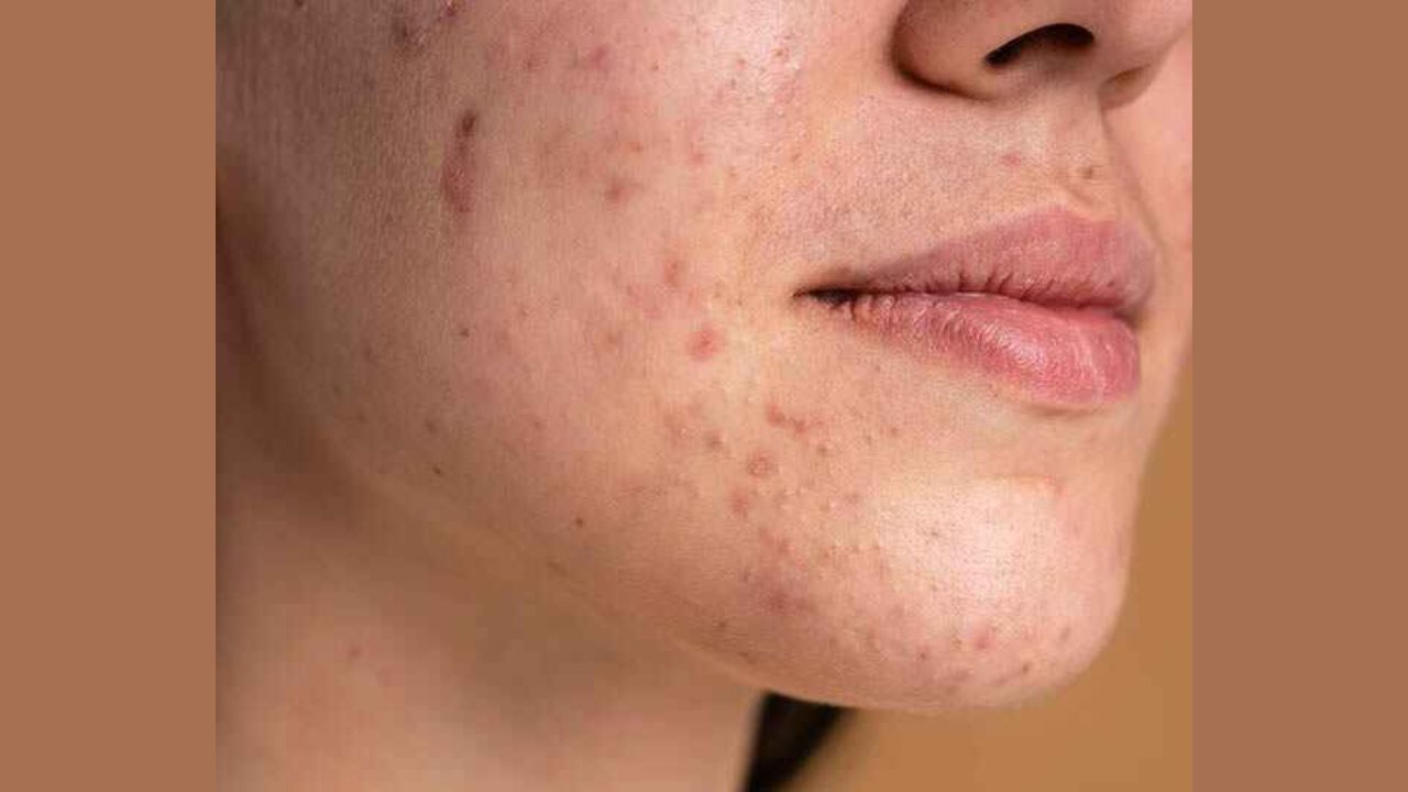 ત્વચાની તમામ સમસ્યામાં માટે : કેસૂડાના બીજની પેસ્ટ બનાવીને ત્વચા પર લગાવવામાં આવે તો ખરજવું અને ત્વચાના અન્ય રોગો મટે છે. આ પેસ્ટ ખંજવાળ અને શુષ્કતાની સમસ્યાને દૂર કરવામાં પણ અસરકારક છે. તેમાં રહેલા એસ્ટ્રિજન્ટ ગુણ ત્વચા માટે ખૂબ જ ફાયદાકારક છે. આ સાથે જો તમે કેસૂડાના પાણીથી સ્નાન કરો છો તો શરીરની ગરમી ઓછી થાય છે તેમજ ઓરી અઠબળા સહિત ત્વચાની સમસ્યામાં રાહત મળે છે.(ફોટો ક્રેડિટ- સોશિયલ મીડિયા)