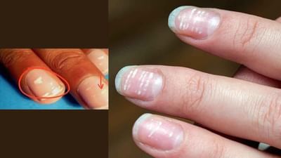 શરીરમાં આ બીમારીને કારણે થાય છે નખ પર સફેદ નિશાન, જાણો તેનાથી છુટકારો મેળવવાના ઘરેલું ઉપાય