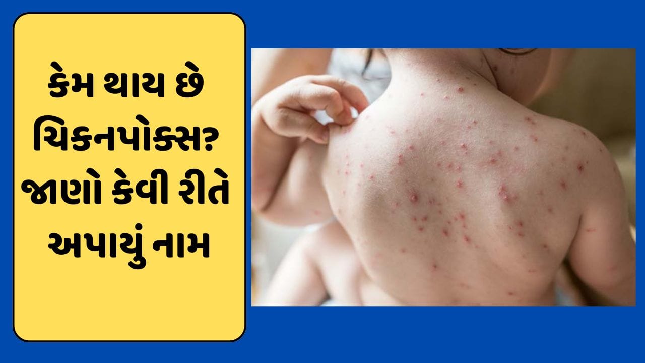 'ચિકનપોક્સ' શું છે અને કેવી રીતે પડ્યું તેનું નામ ? જાણો લક્ષણો સહિતની સંપૂર્ણ વિગત