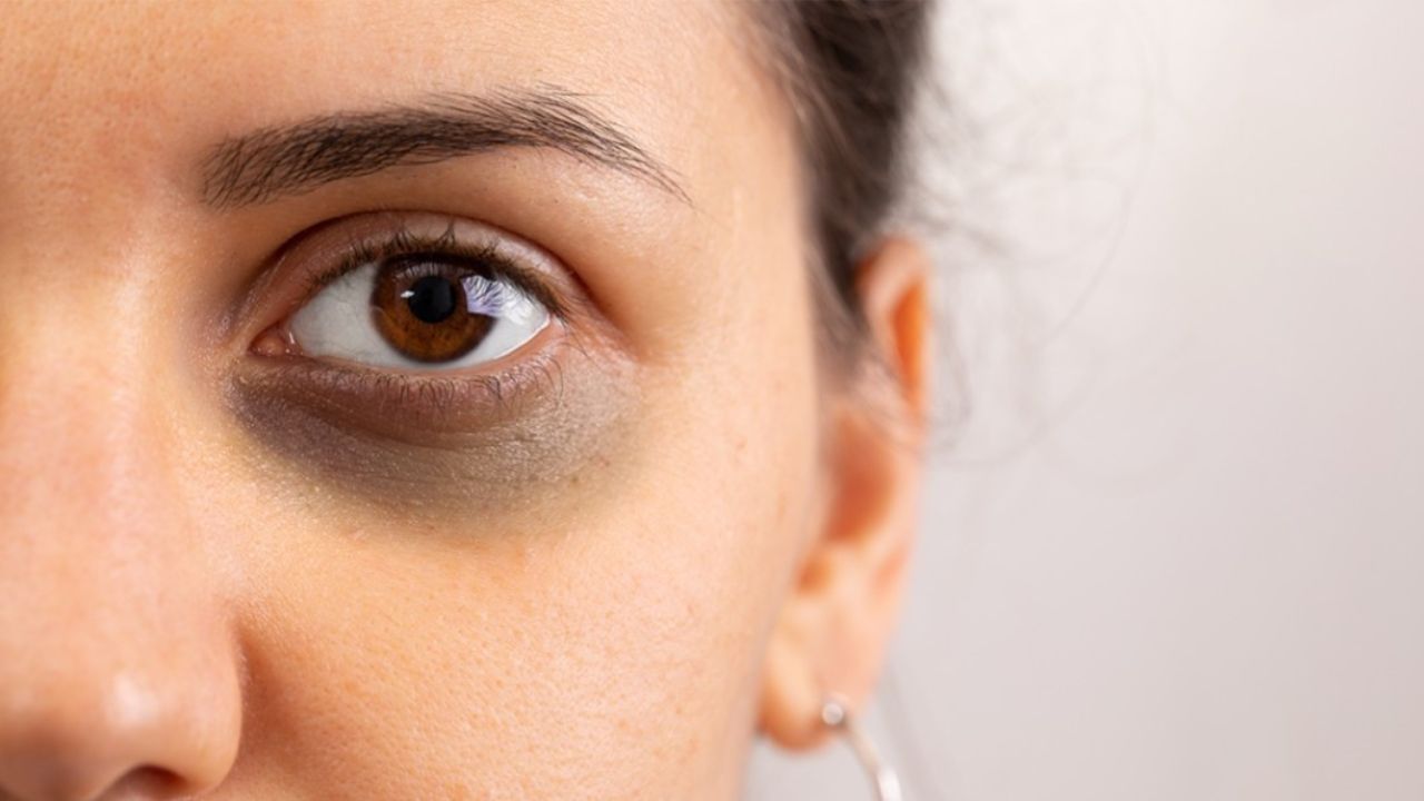 વિટામિનની ઉણપ સિવાય આંખોની નીચે ડાર્ક સર્કલ ખરાબ જીવનશૈલીના કારણે પણ થઈ શકે છે. મોડી રાત સુધી જાગવાથી કે લેપટોપ કે ફોનની સ્ક્રીન પર લાંબો સમય જોવાથી આંખોની નીચે ડાર્ક સર્કલ થઈ જાય અને આખો ઉંડી જતી રહે છે. જેના કારણે તમે બીમાર દેખાવા લાગે છે. આવી સ્થિતિમાં, તેનાથી છૂટકારો મેળવવા માટે તમે ઘરેલું ઉપચાર વડે 1 અઠવાડિયામાં આંખોની નીચેનાં થયેલા ડાર્ક સર્કલને મટાડી શકો છો. તમારે માત્ર એટલું કરવાનું છે કે રાત્રે સૂતા પહેલા તમારી આંખોની નીચે આ લગાવીની સૂઈ જવું.