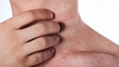 ઉનાળાની ગરમીની સાથે અળાઈઓ પણ નિકળવા લાગે છે અને ચામડી પર લાલ ચકામા પડી જાય છે. અળાઈએ ગરમીમાં નિકળતી ત્વચા સંબંધિત સમસ્યા છે જે આ સિઝનમાં ઘણા લોકો તેનાથી પીડાય છે. આમાં, ગરદન અને પીઠ પર નાની ફોલ્લીઓ દેખાય છે અને એવું લાગે છે કે જાણે કોઈ કાંટા વાગી રહ્યા હોય. 