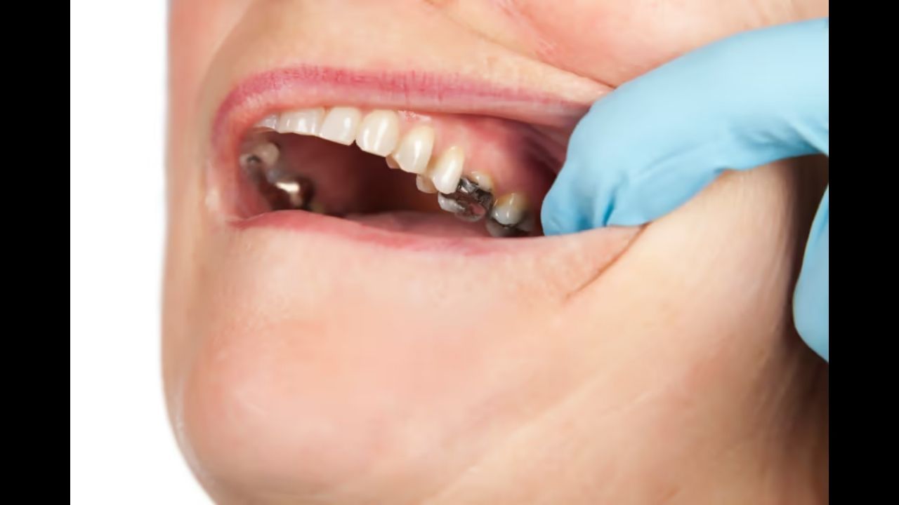 આ સડો મોટે ભાગે પાછળના દાંતમાં થાય છે જે દાંતને અંદરથી પોલા બનાવે છે. દાંતની સપાટી પર કાળા તલના કદનો હોલ દેખાય છે. આ પોલાણને કારણે, દાંત પોલા થઈ જાય છે અને તેમના તૂટવાની અને પડી જવાની સંભાવના છે. સાથે જ દાંતમાં દુખાવો, મોઢામાંથી લોહી નીકળવું અને દાંત પીળા પડવા જેવા લક્ષણો પણ દેખાવા લાગે છે. આ પોલાણને દૂર કરવા અથવા તેનાથી છૂટકારો મેળવવા માટે કેટલાક ઘરેલું ઉપચાર અપનાવી શકાય છે.