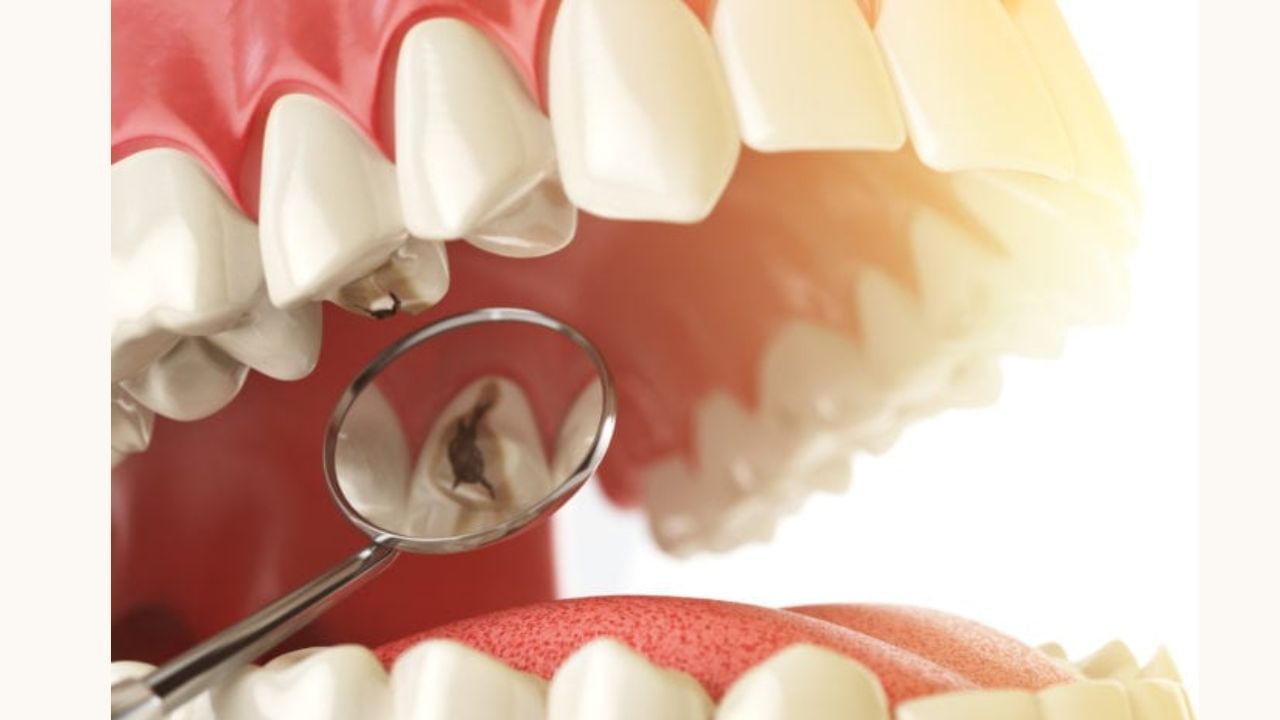 tooth decay and cavity