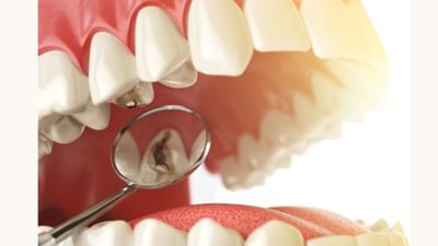 જે લોકો કાર્બોહાઇડ્રેટ યુક્ત ખોરાક ખાધા પછી દાંત સાફ કરતા નથી, જેમાં ખાંડ અને સ્ટાર્ચ જેવા કે કેક, કેન્ડી, દૂધ, બ્રેડ, સોડા વગેરેનો સમાવેશ થાય છે, તેમને દાંતમાં સડો જેવી સમસ્યા થાય છે. આ સડોને કારણે દાંતની સમસ્યાઓ પર પણ નકારાત્મક અસર પડે છે. તમે દાંતના સડો થયા પછી દાંત વારંવાર દુખવા લાગે છે. સફેદ દૂધ જેવા દાત કાળા પડી જાય છે અને તેમાં સડો થાય છે. ત્યારે તમને  ક્યારેક ગરમ અને ઠંડુ ખાવામાં પણ ઘણી તકલીફ થાય છે.