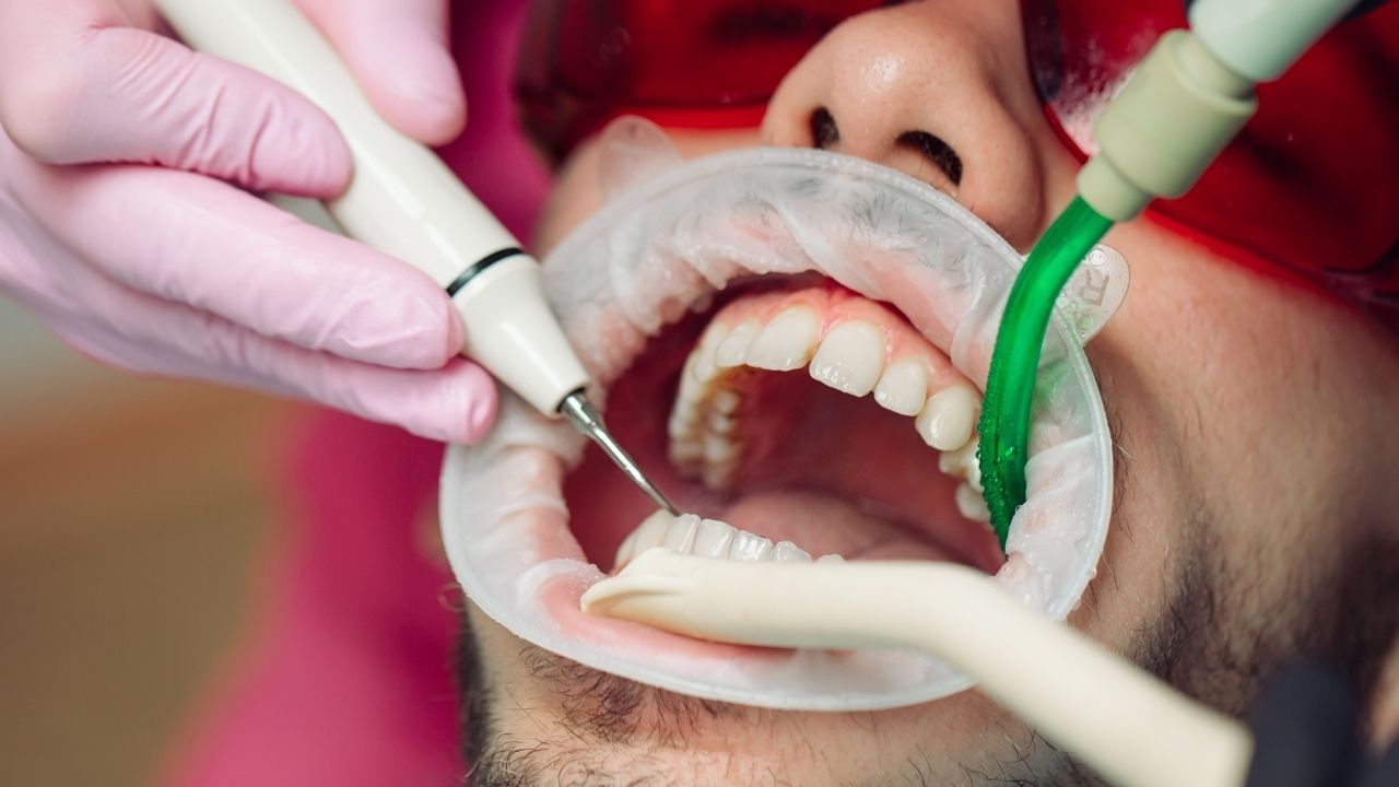 yellow teeth whiten american dental association best effective tips (2)