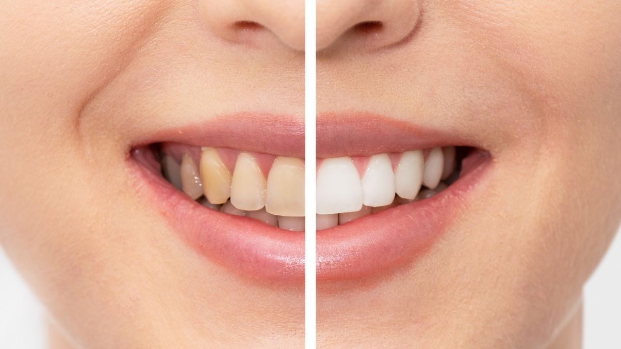 yellow teeth whiten american dental association best effective tips (5)