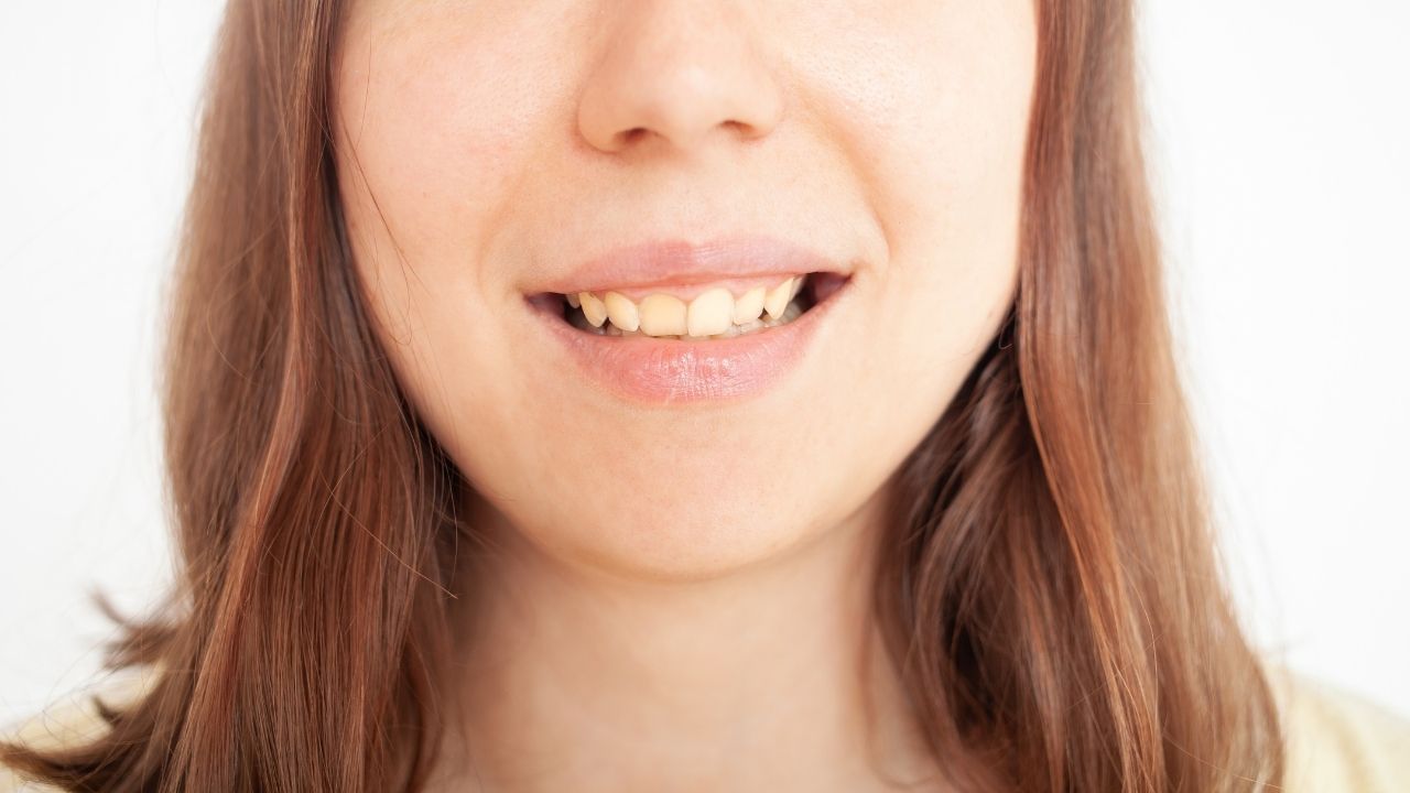 yellow teeth whiten american dental association best effective tips (8)