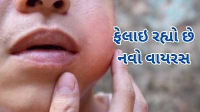 Mumps Outbreak : કોરોના બાદ ફેલાઇ રહ્યો છે આ વાયરસનો પ્રકોપ, બાળકોને બનાવી રહ્યો છે શિકાર, જાણો શું છે લક્ષણ