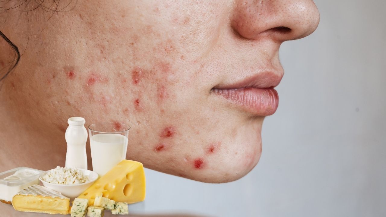 food avoid to get rid of skin Pimples problem (1)