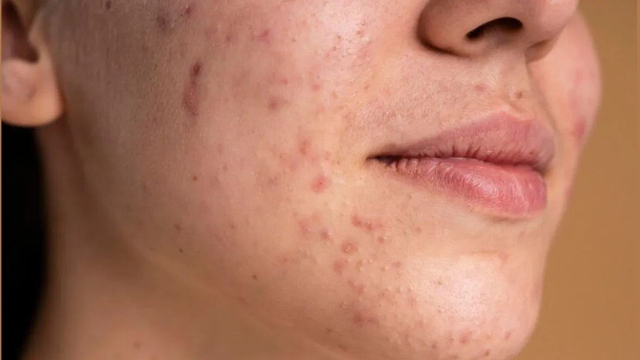 food avoid to get rid of skin Pimples problem (2)