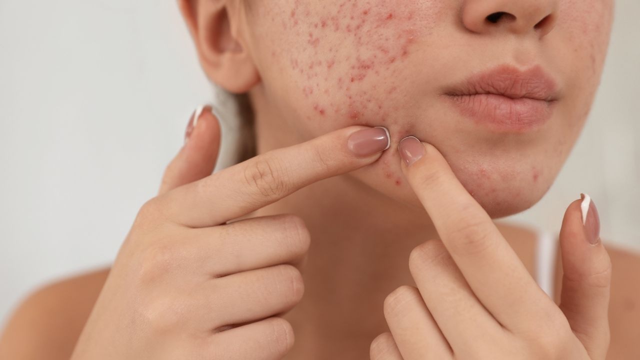 food avoid to get rid of skin Pimples problem (3)