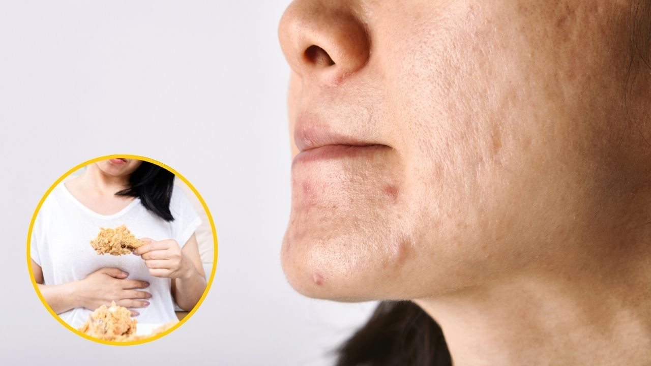 food avoid to get rid of skin Pimples problem (4)