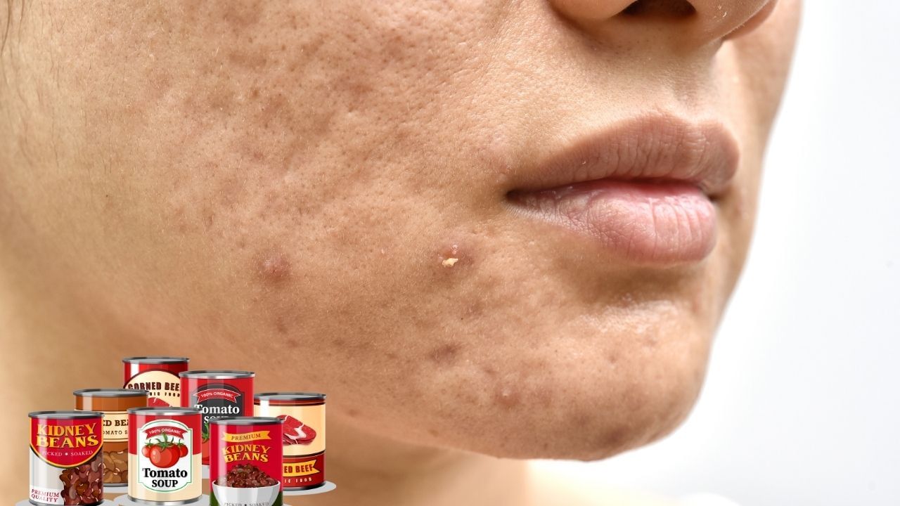 food avoid to get rid of skin Pimples problem (6)