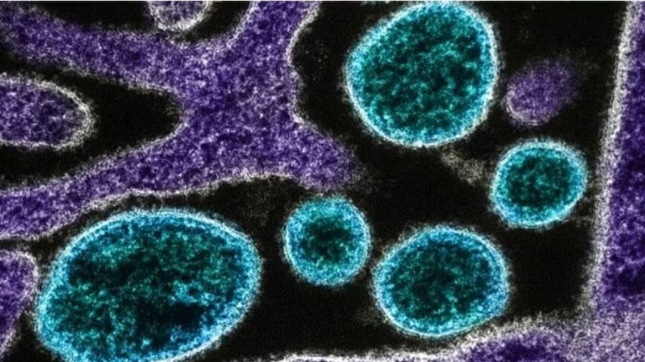 ડેપ્યુટી સીએમએચઓ અંકિત જૈને કહ્યું કે, રાજ્ય સરકાર તરફથી રવિવારે માહિતી મળી હતી કે ઉદયપુર જિલ્લાના ખેરવાડા અને નયાગાંવના બે બાળકોમાં ચાંદીપુરા વાયરસના લક્ષણો જોવા મળ્યા છે. બંનેને ગુજરાતના હિંમતનગરની સિવિલ હોસ્પિટલમાં દાખલ કરવામાં આવ્યા હતા. બાળકોના બ્લડ અને સીરમ સેમ્પલ પુણે મોકલવામાં આવ્યા હતા. તેનો રિપોર્ટ આવવાનો બાકી છે. ડેપ્યુટી સીએમએચઓ અંકિત જૈને જણાવ્યું કે બાળક 26 જૂને ખેરવાડાના બલિચા ગામમાં તેના ઘરે હતો. અચાનક તેને ખેંચ આવવા લાગી.