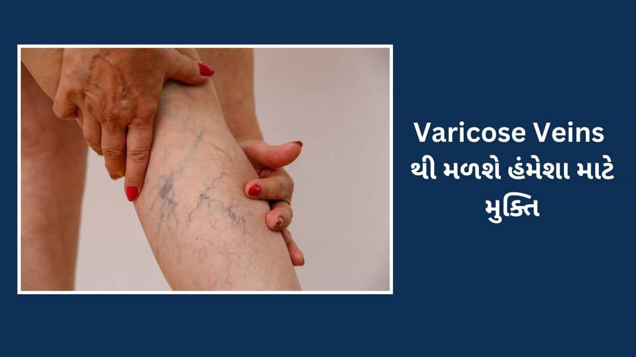 Varicose Veins સમસ્યાથી મળશે મુક્તિ, અજમાવો આ ઉપાય