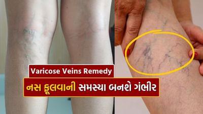 ઘણા કલાકો સુધી સતત બેસી રહેવા અને ઉભા રહેવા, ખરાબ જીવનશૈલી, બ્લડ પ્રેશર અને મેદસ્વીતા જેવી સમસ્યાઓના કારણે વ્યક્તિને વેરિકોઝ વેઈન્સની સમસ્યાનો સામનો કરવો પડે છે. નસો આખા શરીરમાં હૃદયને લોહી પહોંચાડવાનું કામ કરે છે. જ્યારે શરીરમાં લોહી જમા થવાને કારણે નસો ફૂલી જાય છે. જેના કારણે ફ્લેક્સ બને છે. જે વેરીકોઝ વેઈન તરીકે ઓળખાય છે. આ બીમારી વિશે બહુ ઓછા લોકો જાણે છે. જ્યારે ત્વચાની નીચે નસો વધવા લાગે છે ત્યારે તેને વેરિકોઝ વેઇન્સ કહેવામાં આવે છે.