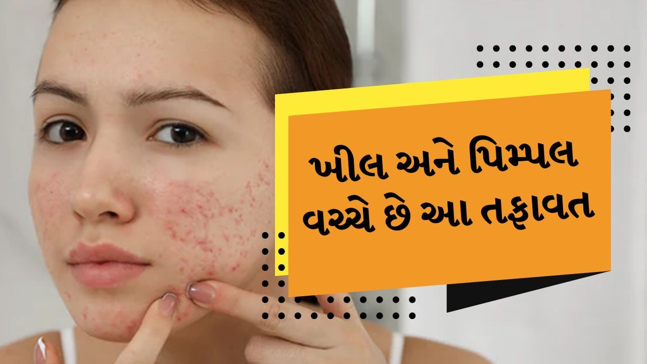 Acne and Pimple : ચહેરા પર ખીલ અને પિમ્પલ્સ એ ત્વચાની સૌથી સામાન્ય સમસ્યાઓમાંની એક છે. આ સમસ્યા મોટે ભાગે ટીનેજર્સ અને યંગસ્ટર્સમાં જોવા મળે છે. હોર્મોનલ અસંતુલન, ખરાબ આહાર, પ્રદૂષણ વગેરે ઘણા કારણો છે જે પિમ્પલ્સ અને ખીલને પ્રોત્સાહન આપે છે. આનાથી છુટકારો મેળવવા માટે લોકો ઘરેલું ઉપચારથી લઈને DIY હેક્સ અને સૌંદર્ય ઉત્પાદનોનો ઉપયોગ વિચાર્યા વિના કરે છે. કારણ કે મોટાભાગના લોકો વિચારે છે કે પિમ્પલ્સ અને ખીલ એક જ છે.
