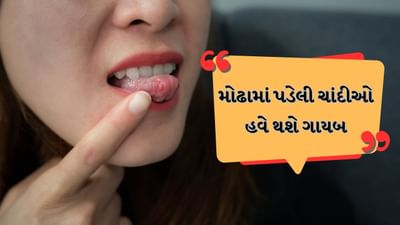 મોઢામાં ચાંદા પડવા એ સૌથી સામાન્ય સમસ્યા છે, પરંતુ તેના કારણે સખત દુખાવો થાય છે અને કંઈપણ ખાવું કે પીવું મુશ્કેલ થઈ જાય છે. મોઢામાં ચાંદા પડવા પાછળના કારણોમાં હોર્મોનલ ફેરફાર, પેટમાં ગરમી, બીજાની જુઠો ખોરાક ખાવો કે પીવો અથવા બ્રશ કરતી વખતે તેની છાલ ઉતારવી, ગરમ ચા કે કોફી પીવી. જો મોઢામાં ફોલ્લા હોય અથવા જીભ અને ગાલની અંદરની ત્વચા પર ફોલ્લીઓ થઈ ગઈ હોય તો તેનાથી રાહત મેળવવા માટે ઘરગથ્થુ ઉપાયો ખૂબ જ અસરકારક છે.