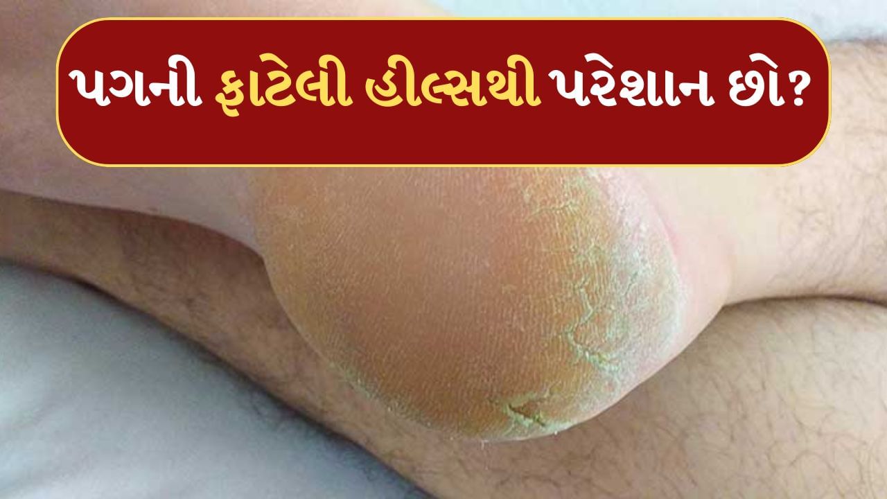 Cracked Heels : ઠંડીની ઋતુમાં માત્ર શરદી-ખાંસી જ નહીં પણ હીલ્સની સમસ્યા પણ થાય છે. આ ઋતુમાં પગની સ્કીન સુકી અને હાર્ડ થઈ જાય છે. આ જ કારણ છે કે હીલ્સમાં તિરાડ થવા લાગે છે અને ક્યારેક તિરાડની હીલ્સમાં ખૂબ દુખાવો થાય છે. ગંભીર કિસ્સાઓમાં હીલ્સમાંથી પણ લોહી નીકળવા લાગે છે.
