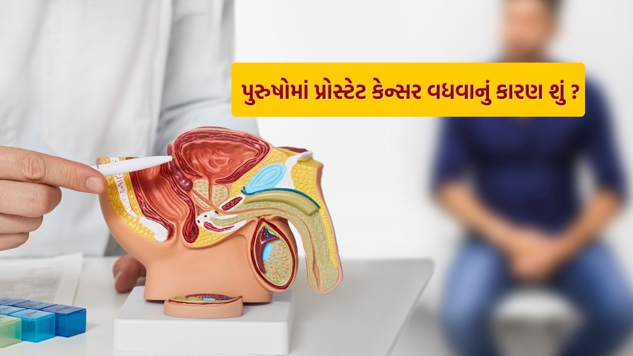 Prostate Cancer અંગે નિષ્ણાતોનું કહેવું છે કે જો આ રોગની વહેલી ઓળખ કરવામાં આવે તો તેની અસરકારક સારવાર કરી શકાય છે. પ્રોસ્ટેટ કેન્સરના કેસો ઘણીવાર ધીમે ધીમે વધે છે, તેથી જ્યારે કેન્સર નોંધપાત્ર રીતે વધ્યું હોય ત્યારે જ તે શોધી શકાય છે.