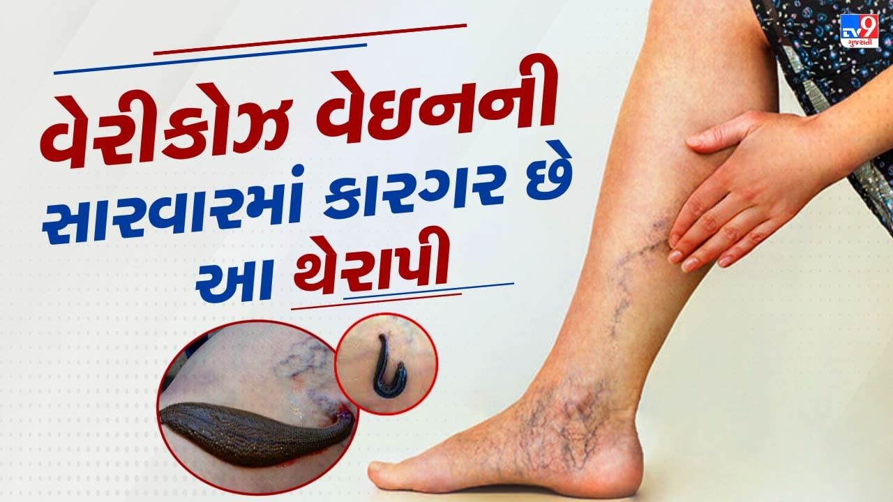 લીચ થેરાપી શું છે ? વેરિકોઝ વેઇન્સમાં કેવી રીતે કરે છે કામ ?