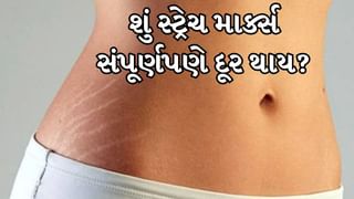 Stretch Marks :  શું સ્ટ્રેચ માર્ક્સ સંપૂર્ણપણે દૂર કરી શકાય છે? જાણો નિષ્ણાતે શું જવાબ આપ્યો