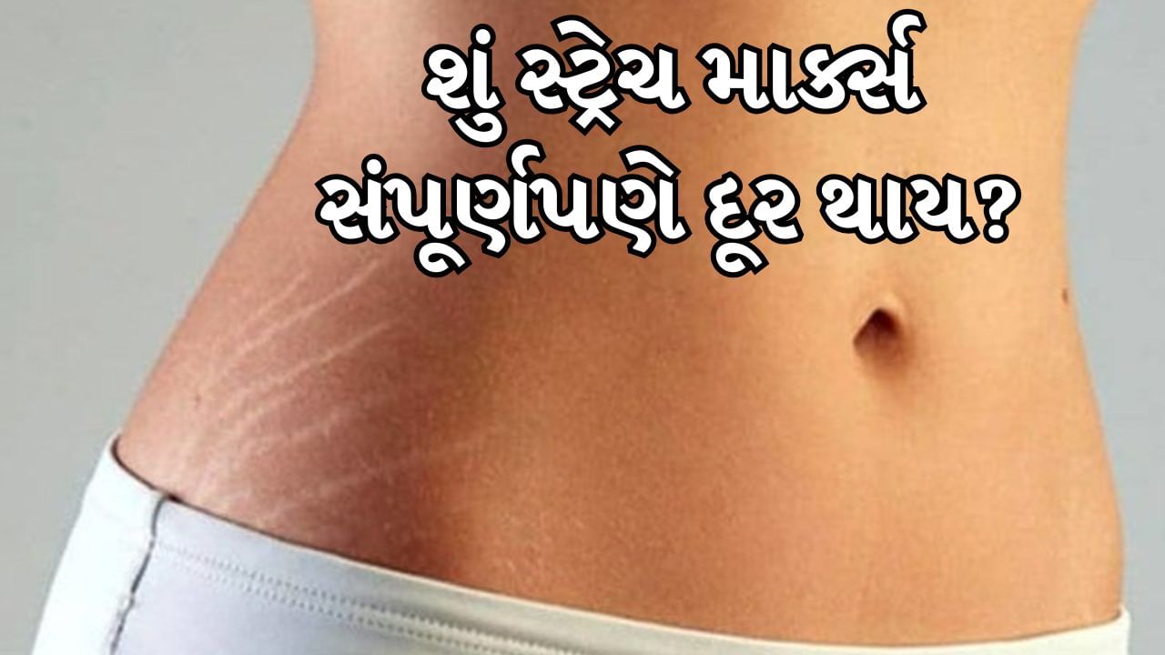 Stretch Marks : સ્ટ્રેચ માર્ક્સ એ ત્વચાની સામાન્ય સમસ્યા છે. આ કોઈને પણ થઈ શકે છે, સ્ત્રી કે પુરુષ. પરંતુ સ્ટ્રેચ માર્ક્સ આત્મવિશ્વાસ ઘટાડે છે. પ્રેગ્નન્સી પછી મહિલાઓ આ સમસ્યાથી ઘણી પરેશાન રહે છે. જો કે આ નિશાન સમય સાથે હળવા થઈ જાય છે, પરંતુ જો તે ઊંડા હોય તો તેને દૂર કરવા માટે દવા અથવા ઘરગથ્થુ વસ્તુઓનો ઉપયોગ કરી શકાય છે.
