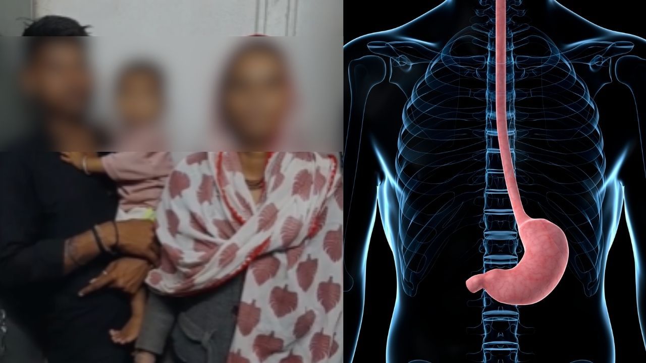 Child's esophagus blocked by Singoda Peel Vadodara Hospital's Successful Surgery (4)