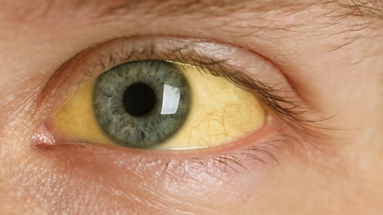 લીવર ફેલ્યોરને કારણે બિલીરૂબિનનું સ્તર વધે છે. આના કારણે ત્વચા અને આંખો પીળી દેખાવા લાગે છે.