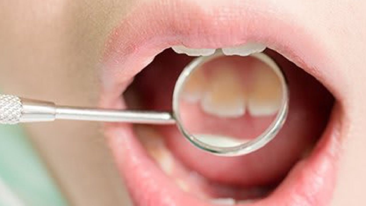 મીઠાના પાણીથી કોગળા : દાંતના સડો અને દુખાવાથી રાહત મેળવવાનો સૌથી સરળ રસ્તો એ છે કે હુંફાળા મીઠાના પાણીથી કોગળા કરો. આ બેક્ટેરિયા અને સોજો ઘટાડે છે. આનાથી દાંતના દુખાવામાં રાહત તો મળે જ છે પણ જો કોઈ પોલાણ હોય તો આ પ્રક્રિયા દરરોજ પુનરાવર્તિત કરી શકાય છે.
