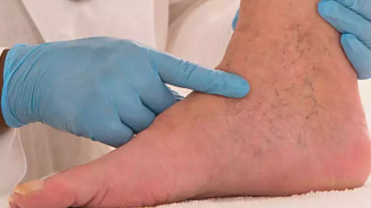 કયા વિટામિનની ઉણપ જવાબદાર હોઈ શકે છે : તમને જણાવી દઈએ કે વિટામિન C, E, D અને મેગ્નેશિયમની ઉણપને કારણે ચેતા નબળી પડી જાય છે. જેના કારણે આ સમસ્યા વારંવાર થઈ શકે છે. સારી વાત એ છે કે જો તમે યોગ્ય આહાર અપનાવો છો, તો દવા વિના પણ તમે આ સમસ્યાથી છુટકારો મેળવી શકો છો.
