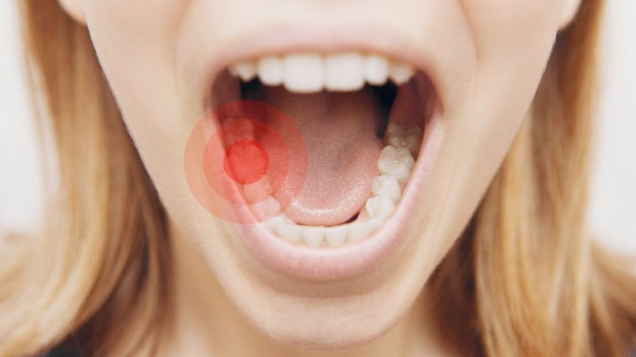 લવિંગ તેલ : દાંતના દુખાવા, પેઢાના સોજા અને પોલાણ ઘટાડવામાં લવિંગ તેલ ખૂબ અસરકારક છે. તેમાં પીડાનાશક અને બેક્ટેરિયા વિરોધી ગુણધર્મો છે. ડોકટરો પણ તેનો ઉપયોગ કરે છે. લવિંગના તેલમાં રુનું પુમડું બોળીને અસરગ્રસ્ત દાંત નીચે દબાવો.
