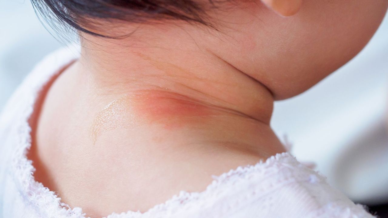 આ વિશે જાણવા માટે અમે ગાઝિયાબાદની જિલ્લા હોસ્પિટલના બાળરોગ વિભાગમાં ડૉ. વિપિનચંદ્ર ઉપાધ્યાય સાથે વાત કરી. ડૉ. વિપિન કહે છે કે નાના બાળકોની ત્વચા પર લાલ ફોલ્લીઓ દેખાય છે. ક્યારેક આ સમસ્યા બે થી ચાર દિવસ પછી ઉકેલાઈ જાય છે. પરંતુ જો તે ઠીક ન થાય તો તમારે ડૉક્ટરનો સંપર્ક કરવો જોઈએ. કેટલાક કિસ્સાઓમાં ત્વચા પર લાલ ફોલ્લીઓ થવાના આ કારણો હોઈ શકે છે.
