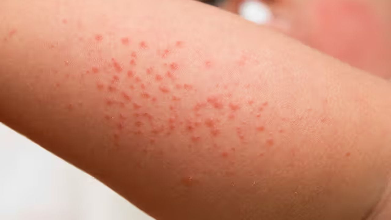 એલર્જી: કેટલાક બાળકોને સાબુ, કપડાં, પાવડર અથવા કોઈપણ ખાદ્ય પદાર્થથી એલર્જી હોઈ શકે છે. જેના કારણે તેમની ત્વચા પર ફોલ્લીઓ થાય છે. જો બાળકોમાં આવી સમસ્યાઓ જોવા મળે તો કપડાં યોગ્ય રીતે સાફ કરવા જોઈએ અને પછી બાળકોને પહેરાવવા જોઈએ.
