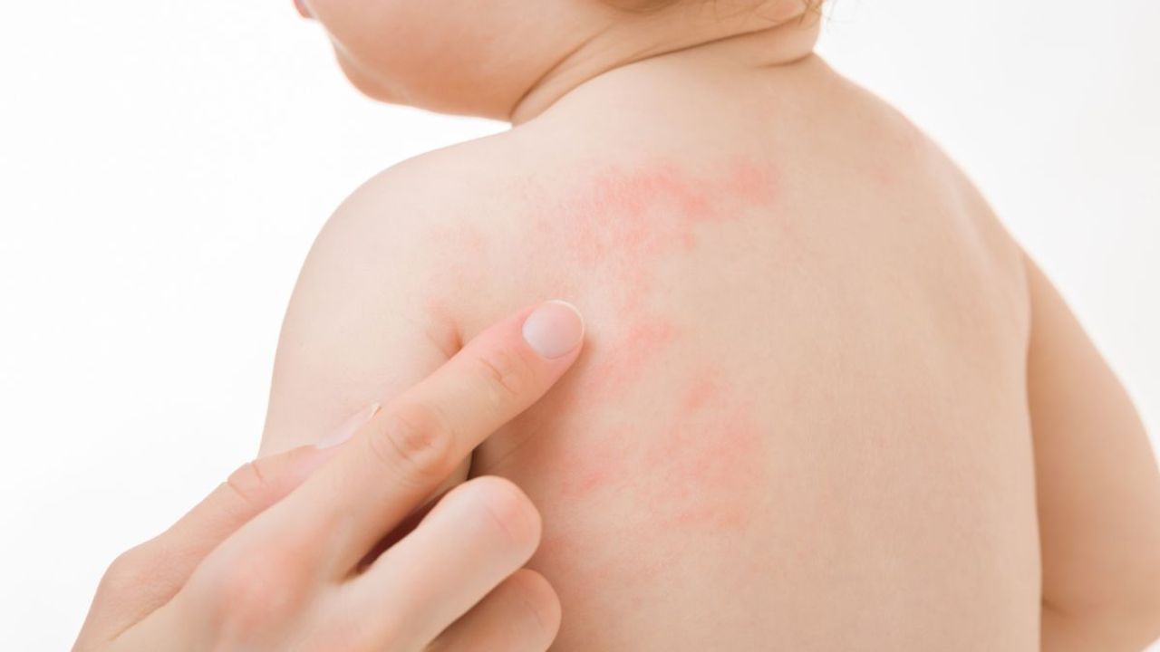 ડાયપરથી ફોલ્લીઓ: ભીના ડાયપરમાં લાંબા સમય સુધી રહેવાથી બાળકની ત્વચા પર લાલ ફોલ્લીઓ અથવા ચકામા થઈ શકે છે. બાળકોમાં ફોલ્લીઓ વધુ અગવડતા લાવે છે. બાળક વારંવાર રડવા લાગે છે.
