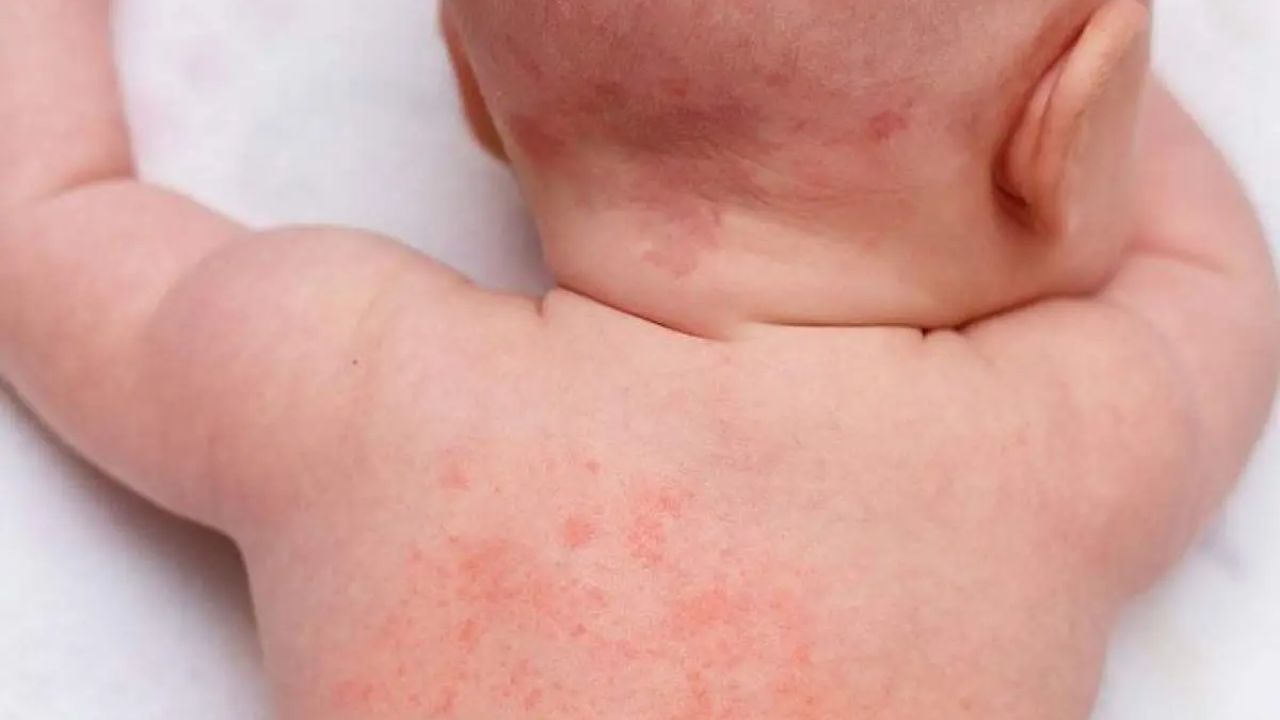 મચ્છર કે જંતુના કરડવાથી: નાના બાળકોની ત્વચા ખૂબ જ નરમ હોય છે. તેથી મચ્છર કે અન્ય કોઈ જંતુ કરડવાથી ફોલ્લીઓ થઈ શકે છે. જો ફોલ્લીઓ દેખાય તો તેને સ્પર્શ ન કરવો જોઈએ. તે પોતાની મેળે સાજા થઈ જશે.
