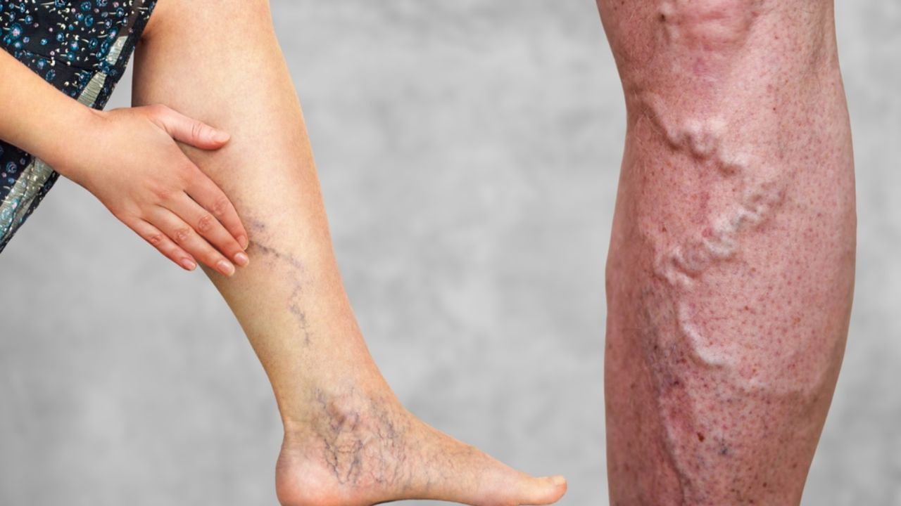 વિટામિન C ચેતાને મજબૂત બનાવે છે : જો શરીરમાં વિટામિન Cની ઉણપ હોય તો ચેતા નબળા પડવા લાગે છે અને સોજો આવવા લાગે છે. આ વિટામિન કોલેજન બનાવવામાં મદદ કરે છે, જે નસોને લચીલું અને મજબૂત બનાવે છે. આ પરિપૂર્ણ કરવા માટે તમારા આહારમાં નારંગી, લીંબુ, આમળા, જામફળ અને પપૈયાનો સમાવેશ કરો.
