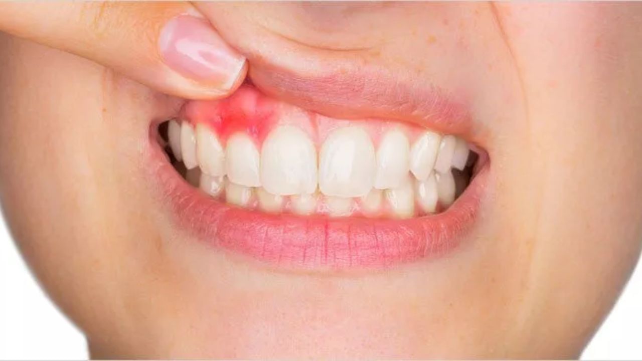 મોટાભાગના કિસ્સાઓમાં આ ફોલ્લા થોડા દિવસોમાં જાતે જ રૂઝાઈ જાય છે. પરંતુ જો આ વારંવાર થઈ રહ્યા છે અથવા લાંબા સમય સુધી સાજા નથી થઈ રહ્યા. તેથી તેમને અવગણવા ખતરનાક બની શકે છે. આ ફોલ્લા શરીરમાં હાજર કેટલીક ગંભીર સમસ્યાઓનો સંકેત હોઈ શકે છે. ચાલો જાણીએ કે મોઢામાં વારંવાર ચાંદા પડવાથી કઈ સ્વાસ્થ્ય સમસ્યાઓ થઈ શકે છે.