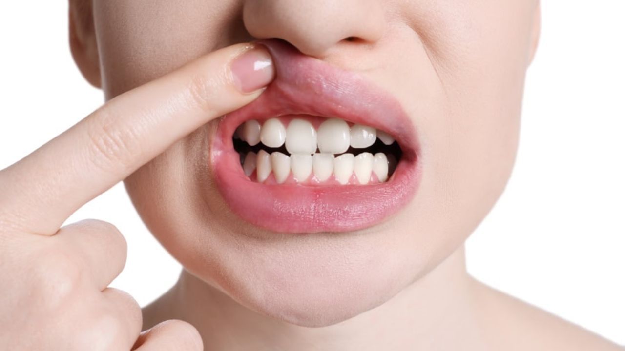 પાચન સમસ્યાઓ : મોઢામાં ચાંદા પડવાનું બીજું કારણ પાચનતંત્રની સમસ્યાઓ હોઈ શકે છે. ગેસ, એસિડિટી, કબજિયાત અથવા અપચો જેવી પેટની સમસ્યાઓ શરીરમાં ઝેરી તત્વોનું સ્તર વધારી શકે છે. જેના કારણે મોઢામાં ચાંદા પડવાની શક્યતા વધી જાય છે. આયુર્વેદ અનુસાર પેટના રોગો અને શરીરમાં પિત્ત દોષ વધવાને કારણે મોઢામાં ચાંદા પડી શકે છે. જો તમને પાચન સંબંધી સમસ્યાઓ હોય અને વારંવાર મોઢામાં ચાંદા પડતા હોય. તો આ શરીરના આંતરિક સંતુલનમાં ખલેલનો સંકેત હોઈ શકે છે.