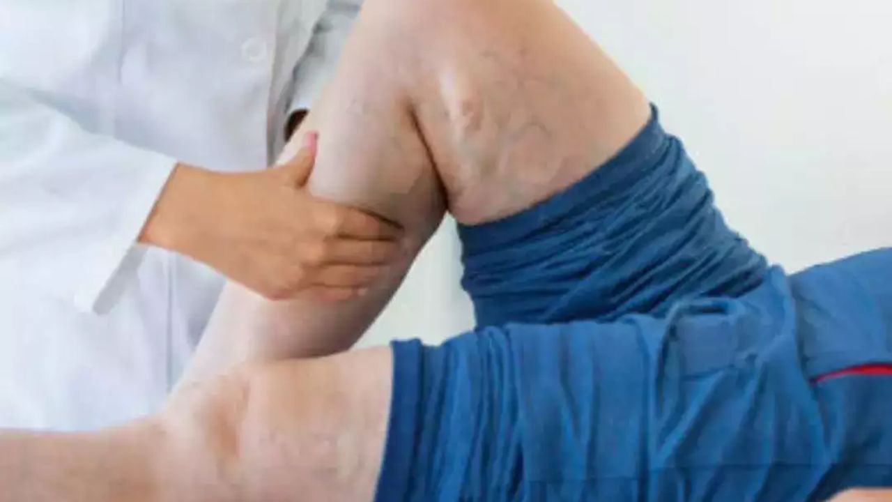 મેગ્નેશિયમ ચેતા તણાવ અટકાવે છે : જો તમને વારંવાર વેરિકોઝ નસોની સમસ્યા રહેતી હોય, તો આ મેગ્નેશિયમની ઉણપનું લક્ષણ હોઈ શકે છે. આ ખનિજ સ્નાયુઓને આરામ આપવામાં મદદ કરે છે અને ચેતા ખેંચાણ ઘટાડે છે. આ પ્રાપ્ત કરવા માટે તમારા આહારમાં કેળા, બદામ, લીલા પાંદડાવાળા શાકભાજી અને બીજનો સમાવેશ કરો.
