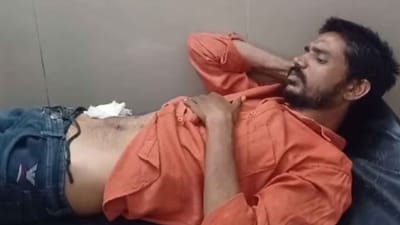 ઉત્તર પ્રદેશના મથુરામાં પેટના દુખાવાથી પીડિત યુવકે પોતાનું ઓપરેશન શરૂ કર્યું. તેણે ઇન્ટરનેટ પર ઓપરેશન કેવી રીતે કરવું તે જોયું. મેડિકલ સ્ટોરમાંથી નમ્બિંગ ઈન્જેક્શન (એનેસ્થેસિયા) ખરીદ્યું. રૂમમાં આવ્યા પછી, જાતે પોતાને ઇન્જેક્શન આપ્યું. પછી પેટના આંતરડામાં એક ચીરો કરવામાં આવ્યો. જે બાદ તેણે ટાંકા લેવાનું શરૂ કર્યું. તેને 12 ટાંકા આવ્યા હોવાથી તેની તબિયત બગડવા લાગી હતી.