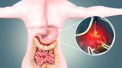 પેટમાં અલ્સર એ એક સમસ્યા છે જે પેટના અંદરના સ્તરમાં ઘા થાય ત્યારે થાય છે. આ ઘા પીડાદાયક હોય છે અને ખાધા પછી અથવા ભૂખ્યા હોય ત્યારે વધુ અનુભવાય છે. પેટમાં અલ્સર થવાના ઘણા કારણો હોઈ શકે છે, જેમ કે હેલિકોબેક્ટર નામના બેક્ટેરિયા, ખાવાની ખોટી આદતો, દવાઓનું વધુ પડતું સેવન, તણાવ, ધૂમ્રપાન અને આલ્કોહોલનું સેવન. આ સમસ્યા કોઈપણ ઉંમરની વ્યક્તિને થઈ શકે છે, પરંતુ તે મોટાભાગે પુખ્ત વયના લોકોમાં જોવા મળે છે. જો સમયસર તેની યોગ્ય સારવાર ન મળે તો તે ખૂબ જ પરેશાનીનું કારણ બની ગંભીર સ્વરૂપ ધારણ કરી શકે છે.