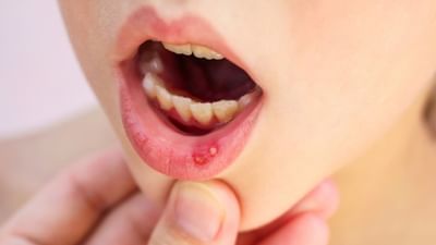 મોઢામાં ચાંદા (Mouth Ulcers) પડવી એ એક સામાન્ય સમસ્યા છે. તમે પણ કોઈને કોઈ સમયે આ સમસ્યાનો સામનો કર્યો હશે. જો મોઢામાં નાનો ફોલ્લો હોય તો પણ તે તીવ્ર પીડા અને બળતરા પેદા કરી શકે છે. ઉપરાંત, જેમ જેમ તે વધે છે તેમ તેમ કંઈપણ ખાવું કે પીવું મુશ્કેલ બની શકે છે. પેટ સાફ ન રાખવું, પેટમાં ગરમી, ઓરલ હાઈજીન ન જાળવવી, ડીહાઈડ્રેશન અને વિટામિન બી, સીની ઉણપ સહિતના અનેક કારણોસર આ સમસ્યા થઈ શકે છે.