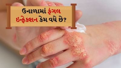 Fungal Infections: ઉનાળામાં તીવ્ર અને સળગતો તડકો ત્વચાને અનેક પ્રકારના નુકસાન પહોંચાડે છે. સૂર્ય અને ગરમીને કારણે ત્વચા પર ગરમીના ફોલ્લીઓ દેખાવા લાગે છે. ઉનાળામાં સૂર્યપ્રકાશને કારણે થતા પરસેવાને કારણે બેક્ટેરિયલ અને ફંગલ ચેપનું જોખમ વધારે હોય છે. ખાસ કરીને જે લોકો દિવસમાં 12 થી 14 કલાક તડકામાં વિતાવે છે, તેમને ત્વચાના ચેપનું જોખમ વધુ હોય છે.