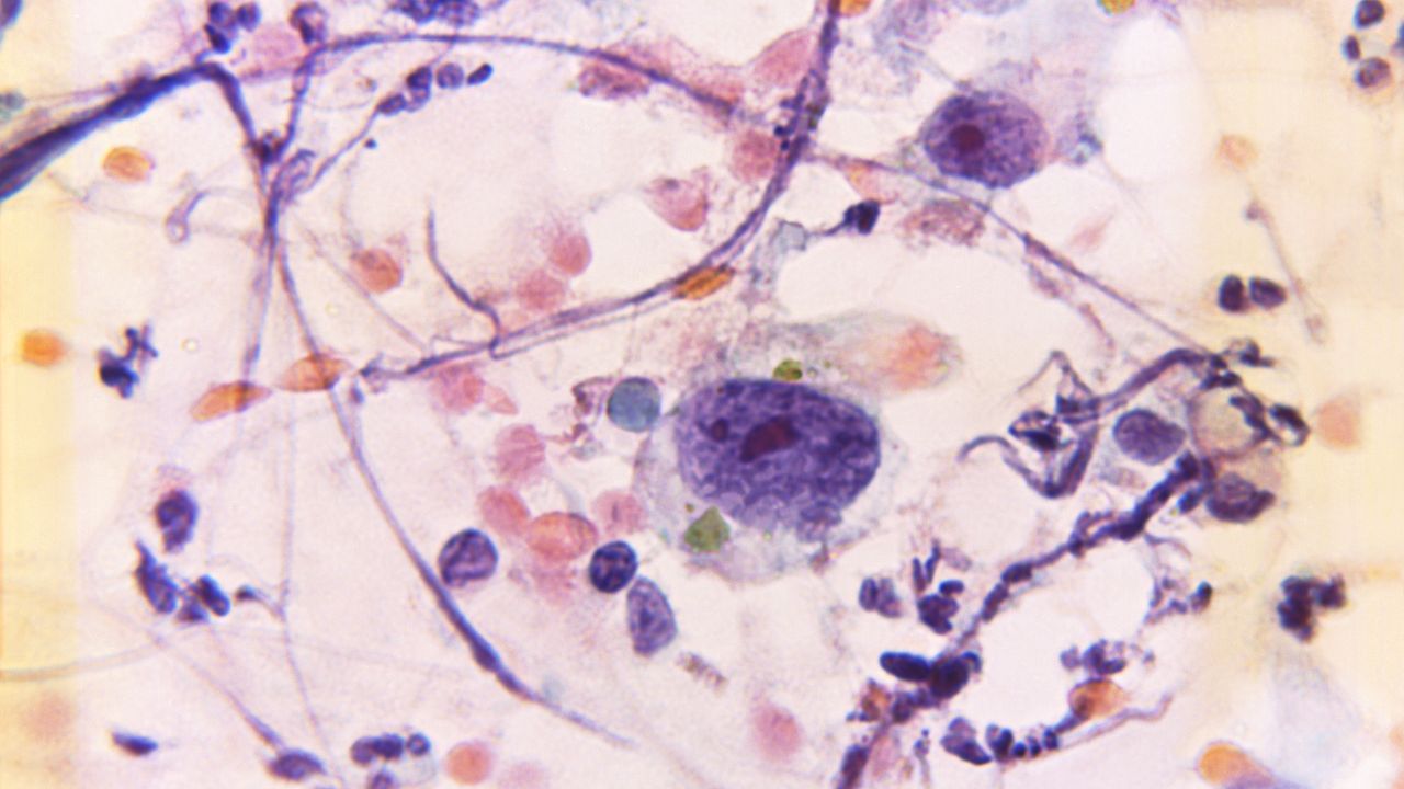 ડોક્ટર કહે છે કે, જો કેન્સરની શરુઆતમાં આની સારવાર થઈ જાય છે તો ખુબ ઓછા ચાન્સ રહે કે, તમને બ્રેસ્ટ કેન્સર ફરીથી થાય. પરંતુ જો કેન્સર બ્રેસ્ટની બહાર ફેલાય જાય છે. તો આની સારવાર બાદ પર ફરી થવાની શક્યતા રહે છે.