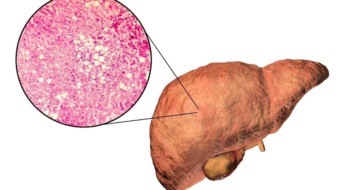 કેટલાક લોકોને પેટના જમણા ઉપરના ભાગમાં હળવો દુખાવો અથવા અસ્વસ્થતા અનુભવી શકે છે, જે ફેટી લીવરનું લક્ષણ હોઈ શકે છે.