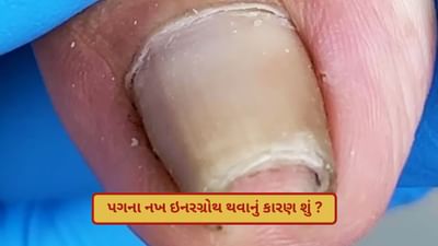 પગના નખ ઇનરગ્રોથ થવાનું કારણ શું ? અંગૂઠાની અંદરની તરફ નખ ઊગવા લાગે તો શું કરવું