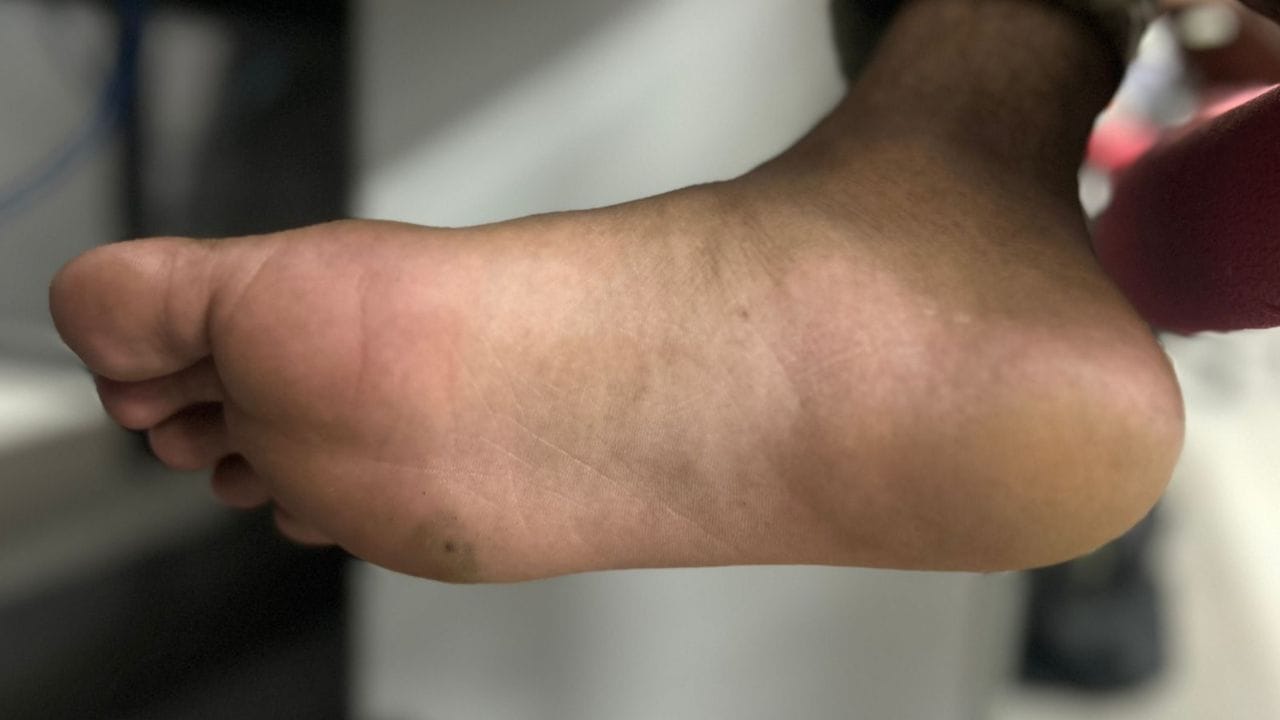 જો તમે આ વિશે કોઈ ડૉક્ટરને પૂછો, તો તમને એક જ જવાબ મળશે કે તમારા તળિયા અથવા અન્ય ભાગોનો રંગ લોહીના અભાવે પીળો છે, તે અયોગ્ય ખોરાકને કારણે પીળો થઈ ગયો છે, પરંતુ સામુદ્રિક શાસ્ત્ર અનુસાર, પીળા તળિયા વ્યક્તિ વિશે ઘણી વાતો કહે છે. જે લોકોના તળિયા પીળા રંગના હોય છે, જેમની આંગળીઓ મોરના પંજા જેવી ખુલ્લી હોય છે, જેમની નસો આગળ હોય છે અને જેમના તળિયા હંમેશા ઠંડા રહે છે, તેઓ જીવનભર આર્થિક તંગીનો સામનો કરે છે જેના કારણે તેઓ હંમેશા ચિંતિત રહે છે. જો તેમને ક્યાંકથી પૈસા મળે તો પણ તેઓ તેને સાચવી શકતા નથી. તેઓ તે પૈસા કોઈ બિનજરૂરી કામમાં ખર્ચ કરે છે અને તેમના ખિસ્સા ફરીથી ખાલી થઈ જાય છે.