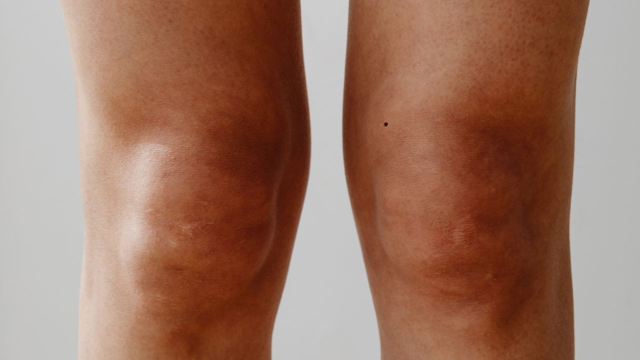 જો કોઈ વ્યક્તિના ડાબા ઘૂંટણ પર તલ હોય તો તેને ઘરના મોરચે અનેક અડચણો આવી શકે છે. આવા લોકો પોતાના પાર્ટનર વિશે ગેરસમજ પેદા કરી શકે છે, જેના કારણે તેમના વૈવાહિક જીવનમાં વારંવાર ઝઘડા થઈ શકે છે. (નોંધ : અહીં અપવમાં આવેલી માહિત શસ્ત્રોમાં આપવામાં આવેલી માહિતી ફક્ત આપની જાણકરી માટે છે.)