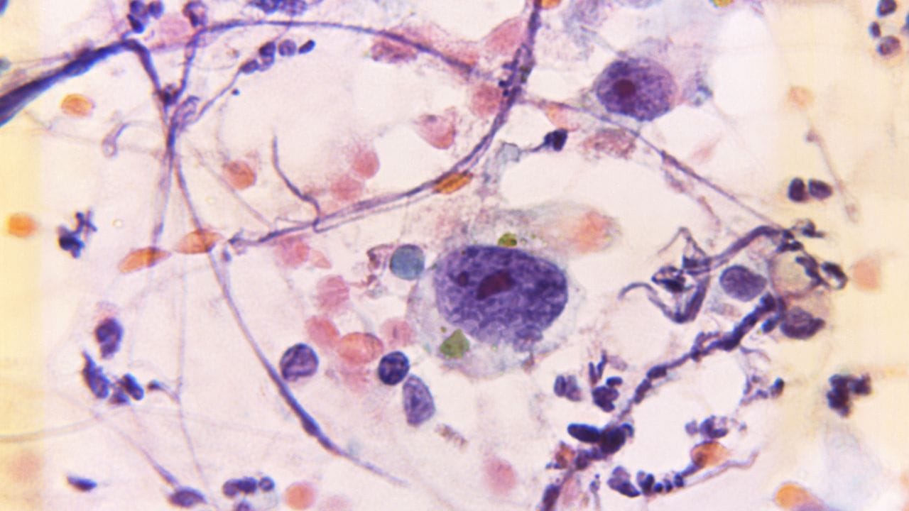 જુલાઈ મહિનો ફાઇબ્રોઇડ જાગૃતિ મહિના તરીકે ઉજવવામાં આવી રહ્યો છે, તેથી આ પ્રશ્નોના જવાબો જાણવા મહત્વપૂર્ણ છે. તો ચાલો આજે આપણે આના વિશે વિસ્તારથી જાણીએ.